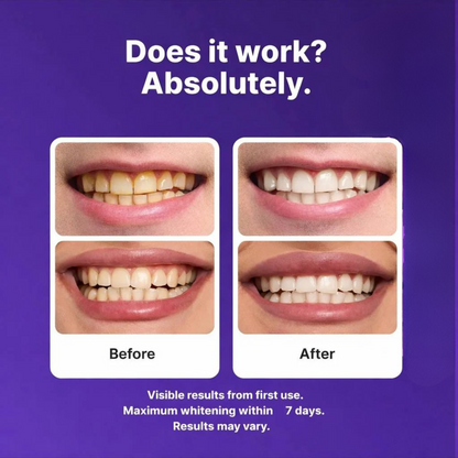 ORBIS Purple Zahnaufhellungsstreifen™